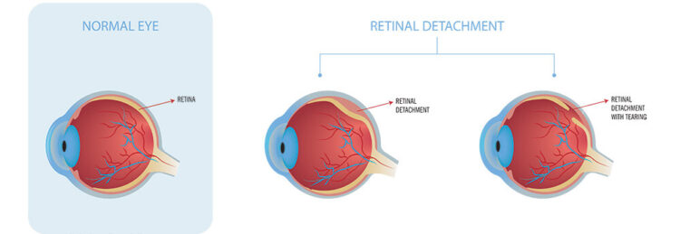 Retinal Tear Hermosa Beach | Retinal Detachment Manhattan Beach